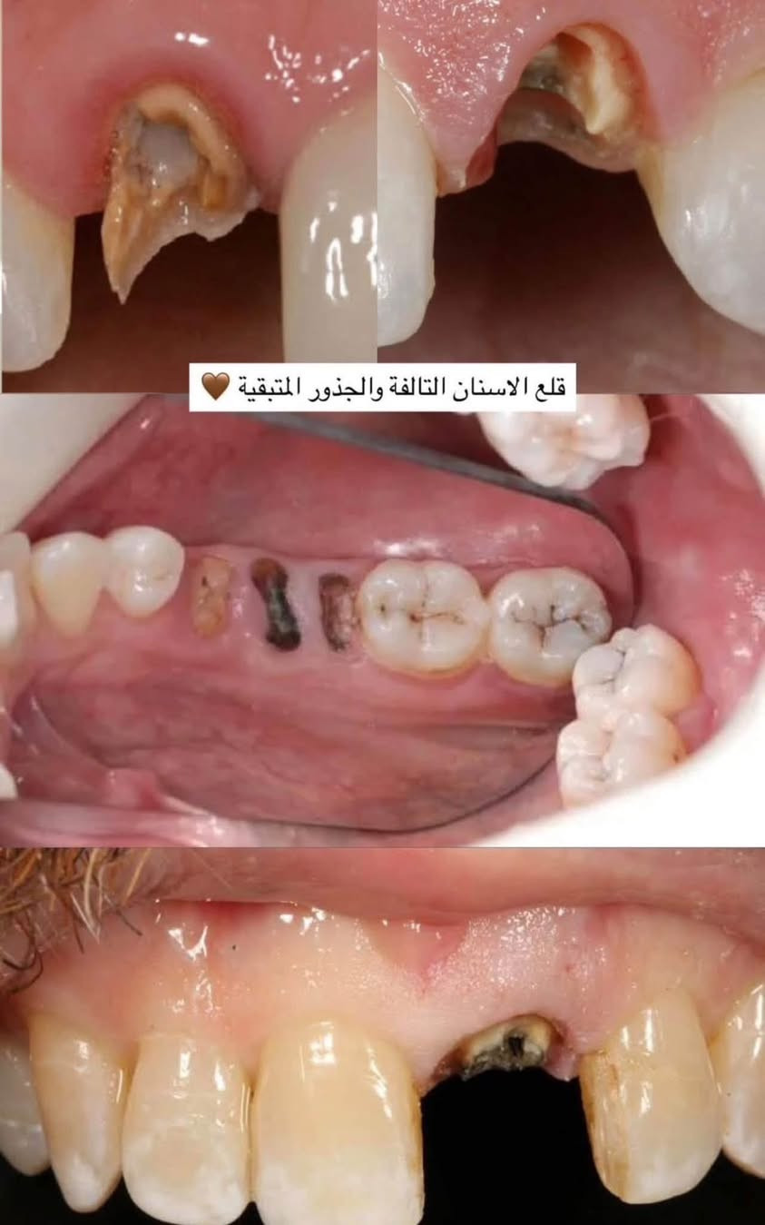 السلام عليكم
يتوفر لدينا عيادات : 
- حشو الاسنان المتسوسه بالحشوات التجميلية ( بيضاء اللون) 
- قلع الاسنان المتحركه والجذور التالفه لكافة الاعمار 
- طقم كامل متحرك
- تقويم اسنان للحالات البسيطه 
- عيادة اطفال تشمل العمر اقل ١٢ سنة 
*** العلاج مجاااني 
العنوان الكرادة شارع ٥٢ 
دايركت او على الرقم
***********

نص مكتوب في الصور:
- كلية طب الاسنان جامعة اوروك
- موجوده عيادة تنظيف اسنان غدا الساعة 10
- الحجز دايركت او على الرقم
- الي عنده تكلسات تصبغات قويه علماً العلاج مجاني
- قلع الاسنان التالفة والجذور المتبقية