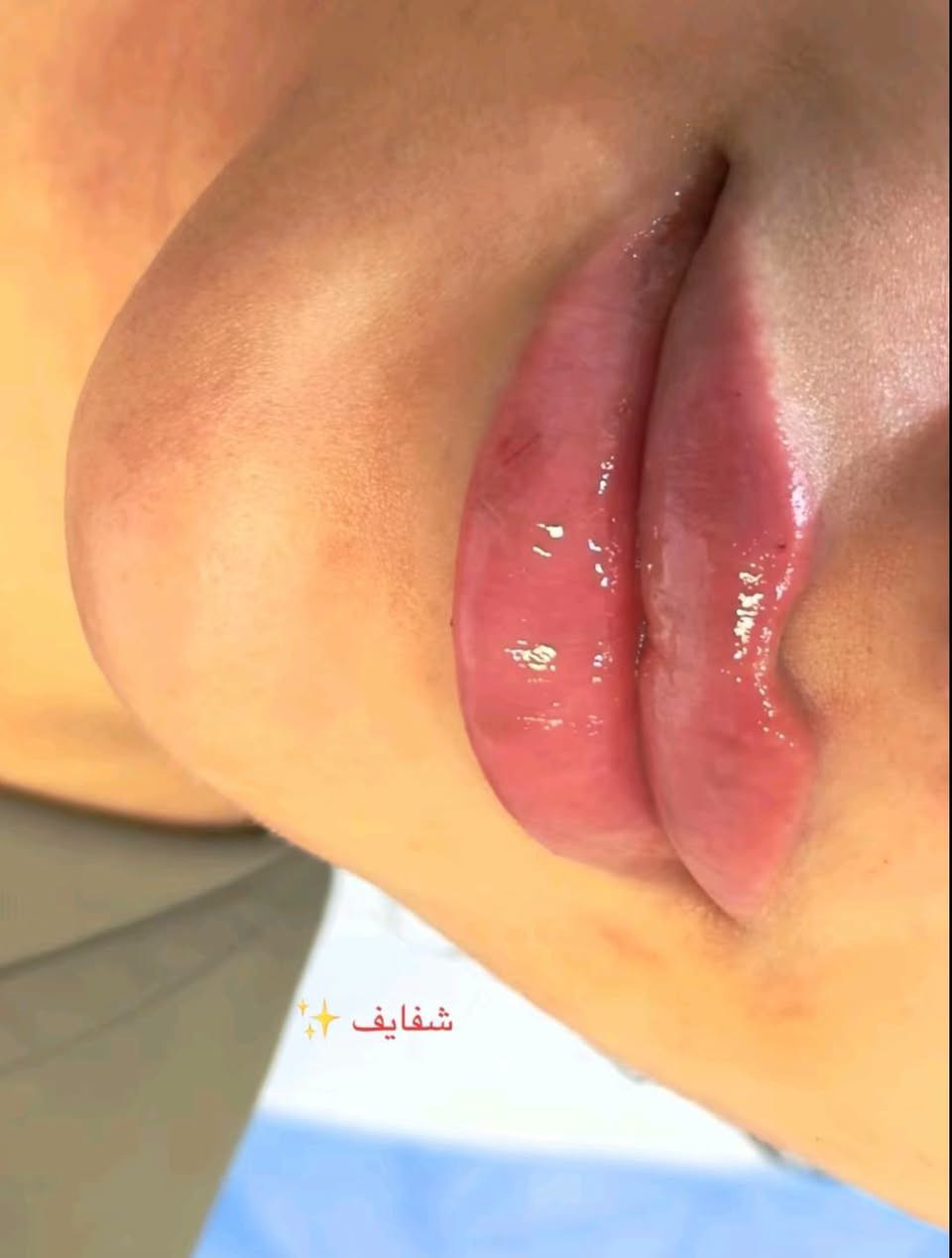 25 ألف فقط
عيادة ايفا للتجميل والأسنان 💉🦷

العنوان #مدينة الصدر الكياره قطاع٦٧ مقابل نادي الجولان

‏‪***********‬‏📞
#اكبلور_العراق_السعوديه_الاردن_ايران_الكويت_طق_لايك_ات_كومنت_يلاا💜_فولو_بغداد_ميوزكلي_ #مدينة #فلر_شفايف #مدينةالصدر

نص مكتوب في الصور:
- شفایف ✨
- شفايف
- دقن