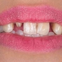 تغليف أسنان • أسعار مناسبة • ميسان الماجدية