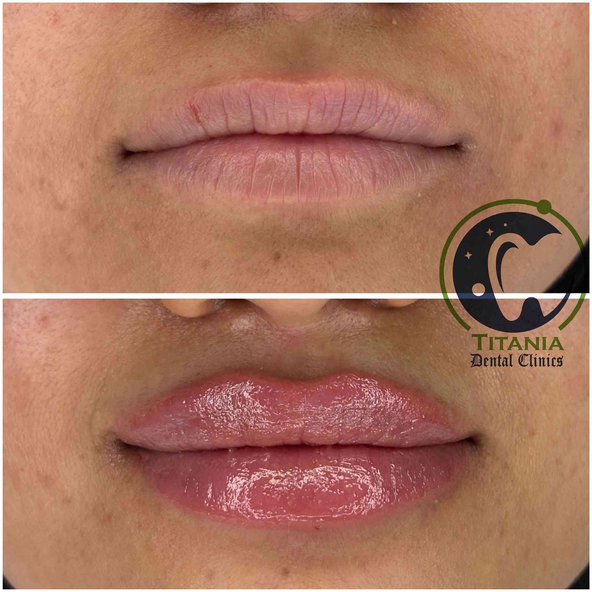 عيادات تيتانيا لطب وتجميل الوجه والاسنان
اطباء اسنان ممارسين بخبرة 7 سنوات
شهادات وعضويات عالمية بمجال التجميل اللاجراحي
تتميز عياداتنا من سنوات بتوفير المواد البراند والاصلية لأول مره بالمحافظة
وجميع المواد المتوفره مسجلة ومفحوصة وتحتوي ختم وزارة الصحة العراقية
..
وتتوفر خدمة الاقساط لحاملي بطاقات مصرف
الرافدين-الرشيد-الاهلي العراقي
..
ميسان-الماجدية-شارع الجامع
للحجز والاستفسار عبر واتس اب
***********
