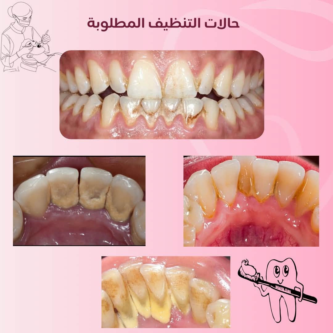 اي استفسار اني حاضرة راسلوني خاص وبعيوني 🤍

نص مكتوب في الصور:
- تجنب وجع الاسنان بالكشف المبكر د/سالي محمد خدماتنا : حشوات ضوئية علاجية للأسنان المتسوسة تنظيف الأسنان وازالة التكلسات وتبييض الأسنان تعويض الأسنان المفقودة بطقم جزئي قلع الأسنان وبقايا الجذور التالفة العلاج مجاني تحت إشراف كادر أطباء مختصين العنوان : جامعة البيان - مستشفى البيان التعليمي بغداد - شارع المطار *********** Sos19m_ Soss204
- حالات التنظيف المطلوبة
- حالات التسوس :
- الحالات التي تستوجب تعويضها ب طقم جزئي متحرك :
- الاسنان وبقايا الجذور التي تستحق القلع: