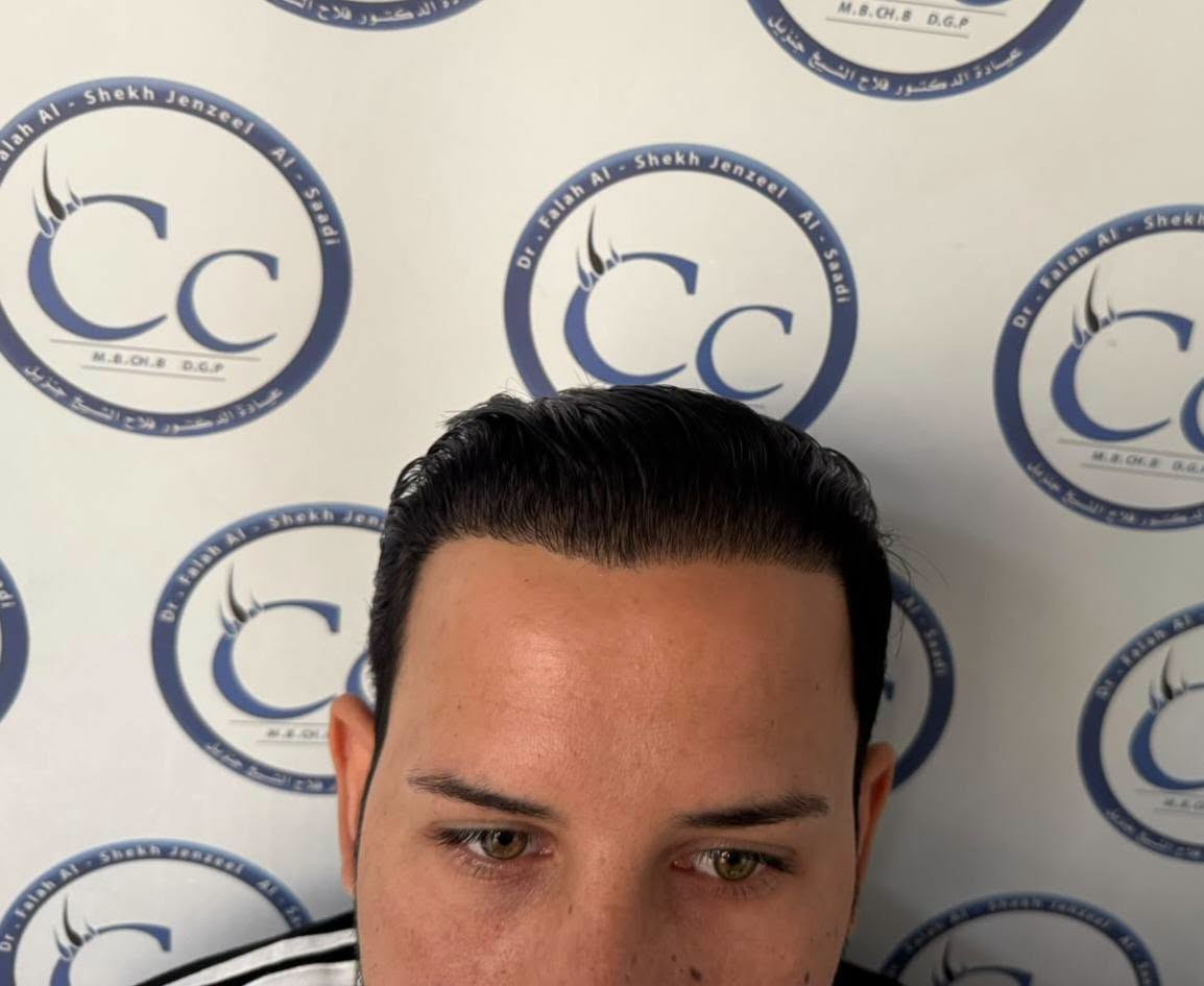 زراعة شعر • نتائج بعد سنتين • فلاح الساعدي