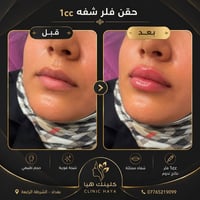 شفايف ناعمة، متناسقة، وبنتيجة طبيعية تبرز جمالك بدون مبالغة. ✨💋  في كل...