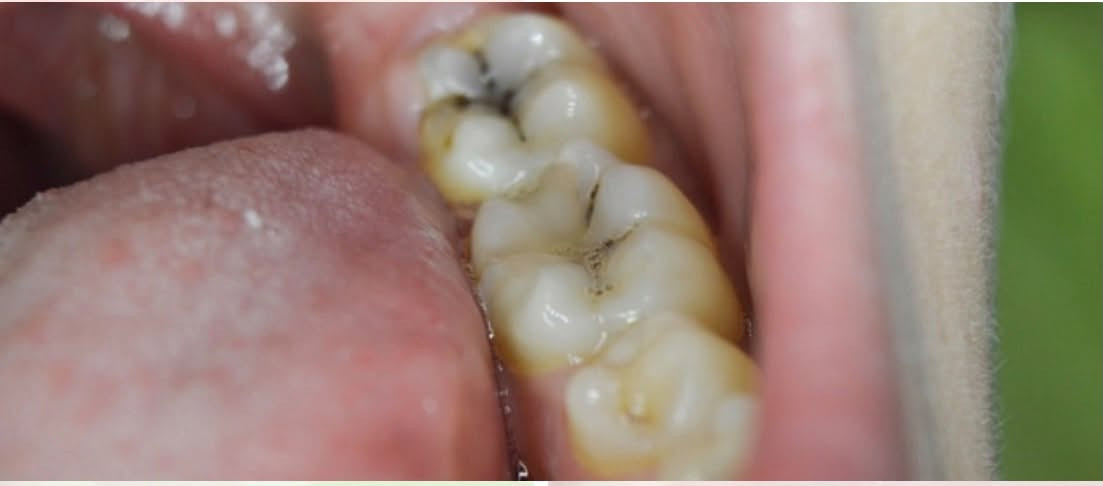 سلام عليكم المحتاج تنظيف اسنان وحشوات تجميلية يراسلني ع هذا الرقم *********** الشغل مجاني بالكامل عنوان العيادة الجبيلة قرب مول تايم سكوير مقابل مول السلطان متواجدة يوم السبت والاحد فقط
