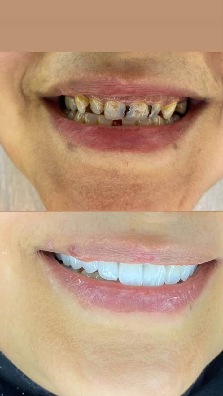 🦷✨ ابتسامة طبيعية… جمال يليق بك
لأن أجمل الابتسامات هي التي تجمع بين الطبيعية، التناسق والجمال، نحرص في عيادة الرياحين لطب وتجميل الأسنان على تصميم ابتسامة متناغمة مع ملامح الوجه، بلون وشكل طبيعي يمنحك ثقة أكبر وابتسامة أجمل. 🤍
ابتسامتك تستحق عناية خاصة… والجمال يبدأ من ابتسامة صحية وطبيعية.
📍 حله / حي الامام / مقابل كرار ابو الكص / عياده الرياحين 

📞  واتساب ***********
