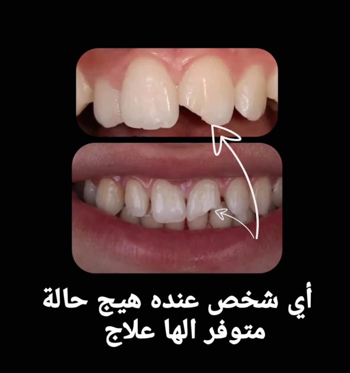 علاج مجاني • قلع أسنان • حشوات جذور