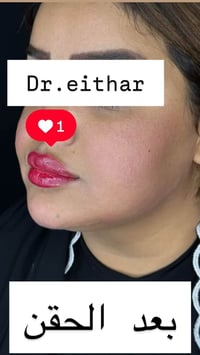 كونتور الوجه • فيلر • واسط الكوت