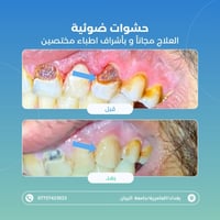 علاج مجاني • جامعة البيان • حشوات ضوئية