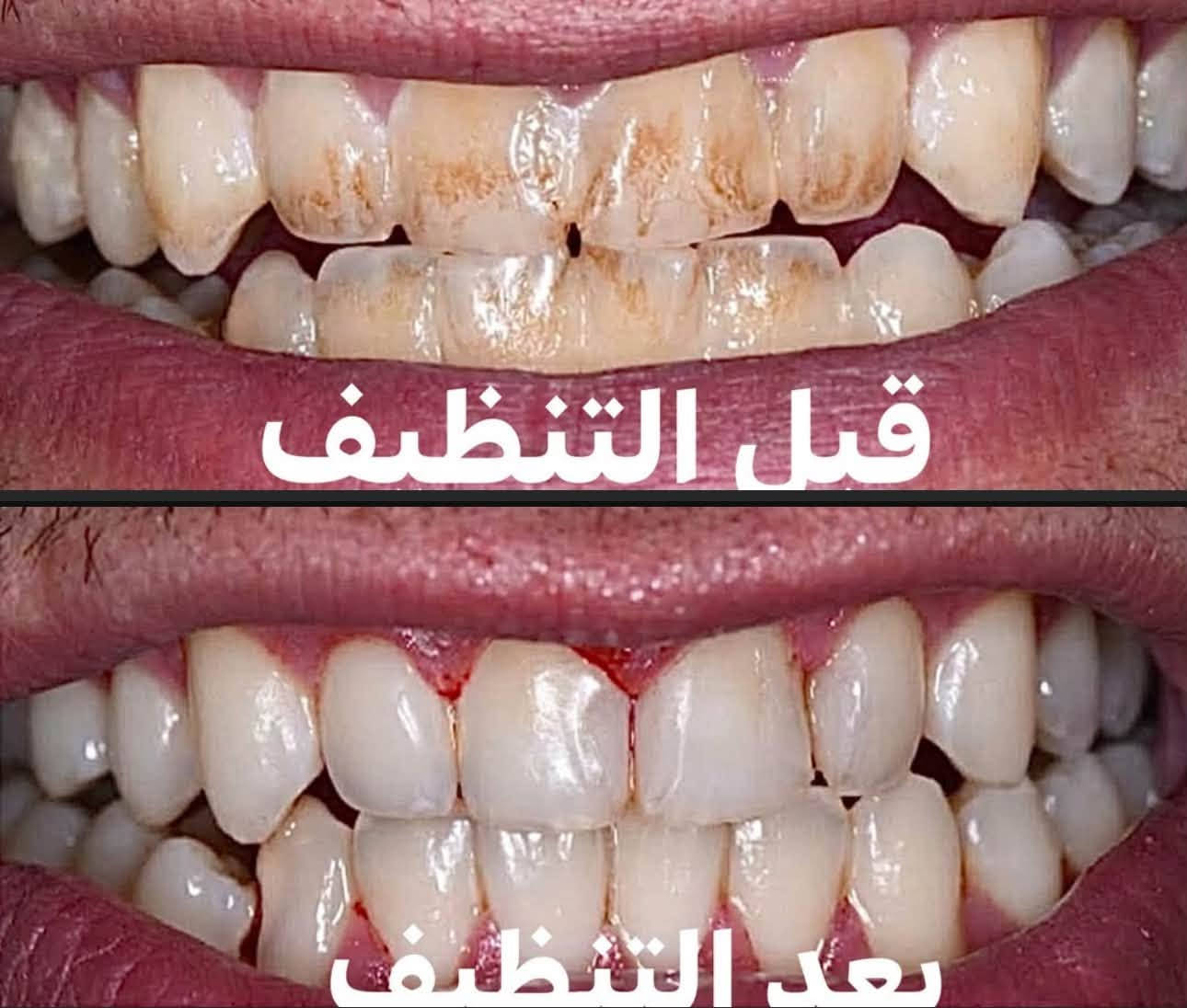 حشوات تجميلية • تنظيف أسنان • شبه مجانية