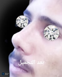 تجميل الانف • طبيعي • قبل وبعد