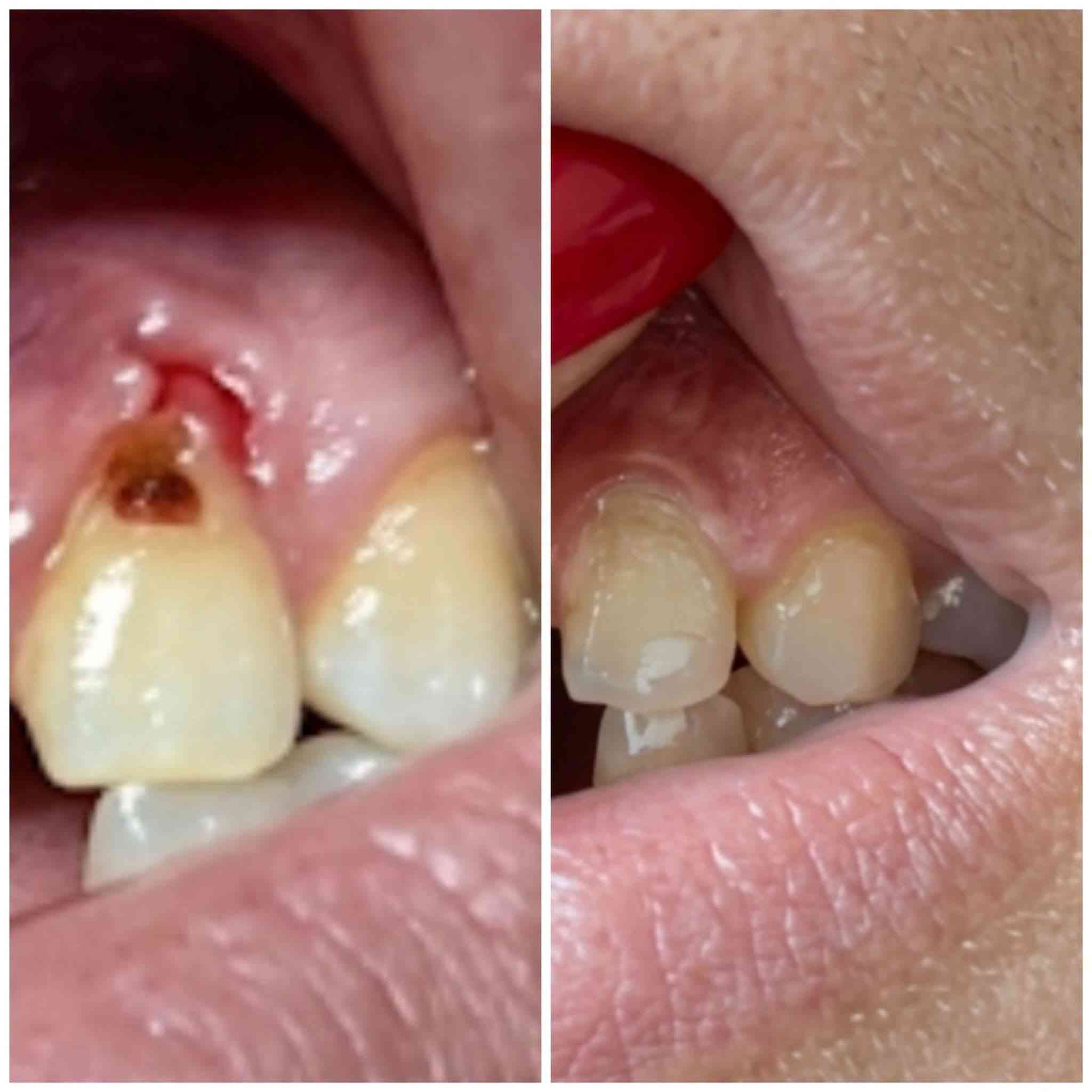 على بركة الله نعاود استقبال الحالات التالية في عيادات جامعة الحلة 🦷
-الحشوات الضوئية (الحشوة البيضاء)
_تنظيف الاسنان وازالة التكلسات 
_قلع الاسنان التالفة والجذور المتبقية
_تعويض الاسنان المفقودة بطقم كامل
_قلع وحشوات ومعالجة اسنان الاطفال

🔴العلاج بشكل شبه مجاني 

الموقع🔻 :شارع اربعين،مجاور صيدلية سلامتك

للحجز والاستفسار📞: ***********

نص مكتوب في الصور:
- Before