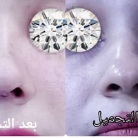 تجميل أنف • طبيعي • عيادة الياسري