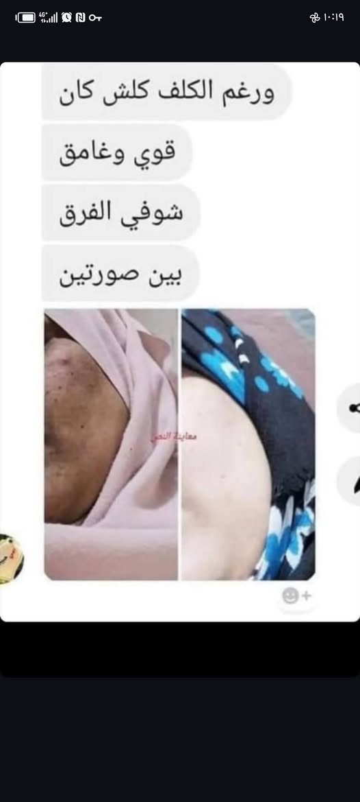 بنات العرض ع الخلطه الايرانيه العشبيه
٢٠ والتوصيل مجاني لحد الجمعه ويخلص العرص

نص مكتوب في الصور:
- In quiet mode هاي بعدنه ماكملت لا شهر ولا العلبه كلها بالكامره الاماميه مالت لايفون ماشاءالله تخبل تخبل حبيبي الفضل الج اكيد جانت دهنيه بشكل هسه متوازنه وتخبل عافيات هوه حلو بي يوازن دهون منع حبوب
- ماشاءالله تحسن حلو تمييز كعميل محتمل تعديل
- ورغم الكلف كلش كان قوي وغامق شوفي الفرق بين صورتين
- الله
- تدللين حياتي
- ماشآء الله وجهها مثل الورد صار الفضل الله والج بدون مجامله جان يلعب النفس
- واني لو تشوفين وجهي ماشآء الله
- مليون عافيه عليكم ياربي
- صلوات
- نعم تركيزة اقوة Unread messages كون وجهي يسمن بسرعه قبل شهر اخذت من عندج كبسول مبيض يجنن سو البياض عندي جنت حيل سمره هسه ماشاء الله يجنن واريد مصداقيتج بتسمين وجهي فدوه دكتوره
