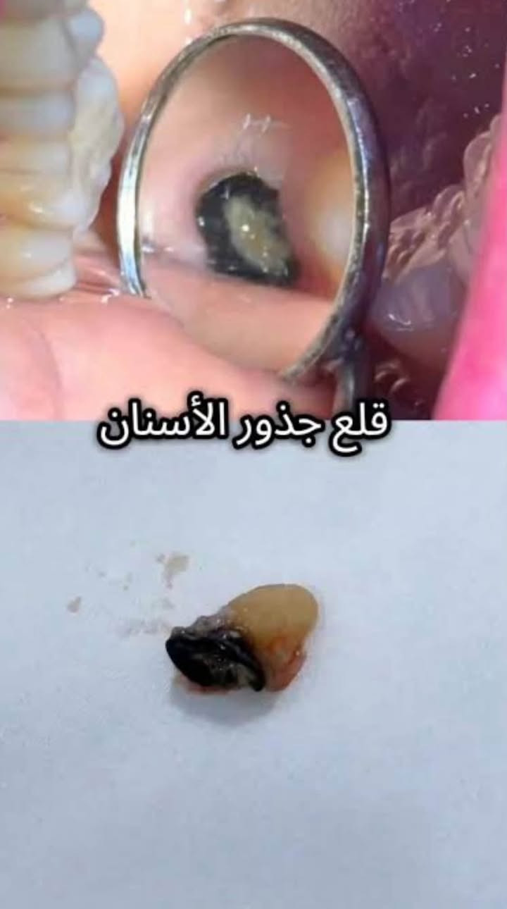 ازالة بقايا جذور الاسنان التالفة
مجاناً
العنوان/عيادات جامعة ابن سينا
بغداد- القادسية-مقابل محطة وقود البياع
التواصل واتساب/***********

**علماً بان بقاء هذه الجذور يسبب التهابات وتلف لعظم الفك والانسجة المحيطه

نص مكتوب في الصور:
- قلع جذور الأسنان
