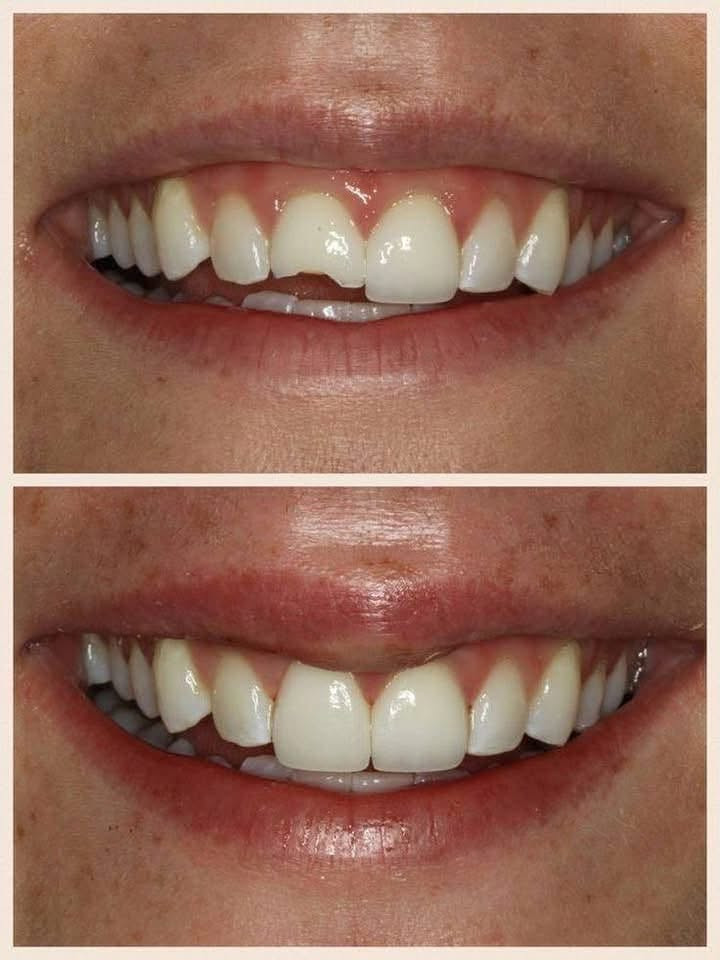 مجاناً 🦷
علاج الأسنان
 ، حشوات ضوئيه ، تنظيف الأسنان ، قلع ، اطقم للأسنان المفقودة (اسعار رمزيه جداً )
عيادات جامعة النور 📍

للتواصل على الخاص او واتساب ***********

