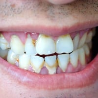 تنظيف أسنان • مجاناً • تكلسات