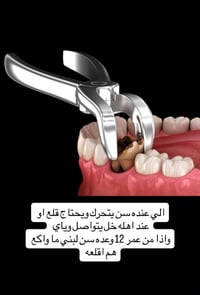 قلع اسنان • مجانا • الكرادة شارع ٥٢