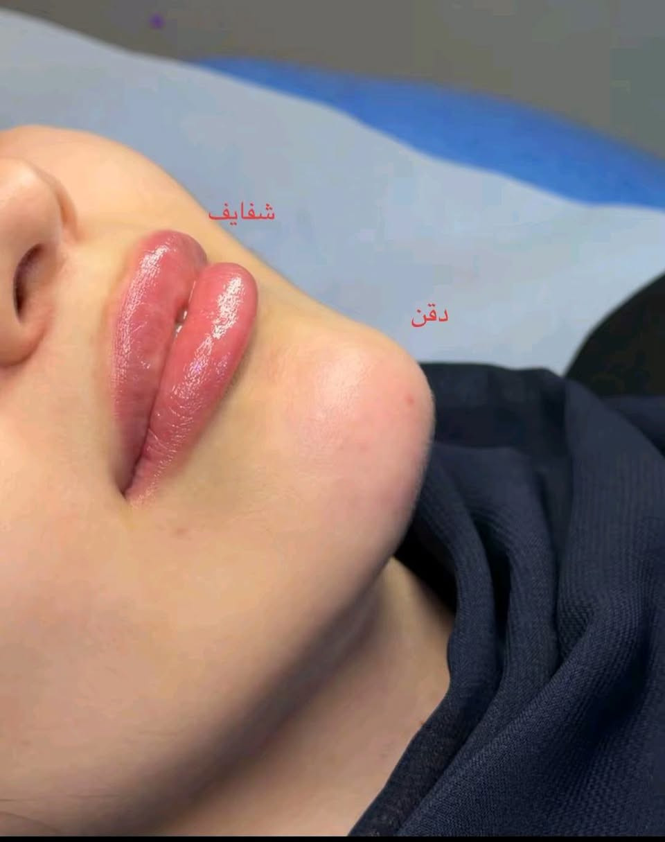 25 ألف فقط
عيادة ايفا للتجميل والأسنان 💉🦷

العنوان #مدينة الصدر الكياره قطاع٦٧ مقابل نادي الجولان

‏‪***********‬‏📞
#اكبلور_العراق_السعوديه_الاردن_ايران_الكويت_طق_لايك_ات_كومنت_يلاا💜_فولو_بغداد_ميوزكلي_ #مدينة #فلر_شفايف #مدينةالصدر

نص مكتوب في الصور:
- شفایف ✨
- شفايف
- دقن
