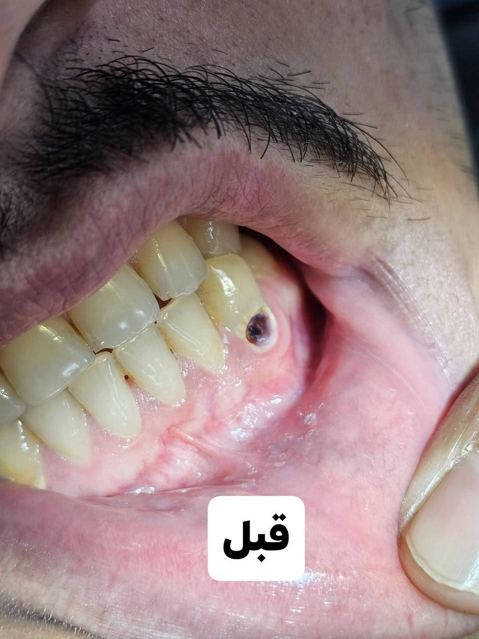 السلام عليكم و رحمة الله
مثل ما تشوفون بالصور كل هل حالات الي موجودة هي الها حلول ان شاء الله يمنة و نگدر نساعدكم بعلاجها تگدر تشوف الصور و تحدد لي شنو المشكلة الي تعاني من عدها و ما عليك الا ان تراسلنا و احنا ننطيك خطة العلاج الكاملة و كل هذا الشي مجاني و تحت اشراف اطباء اختصاص 

📍 الموقع: تقاطع القدس – جامعة بلاد الرافدين
🏥 عيادة كلية طب الأسنان
📞 للحجز والاستفسار: *********** واتساب فقط
