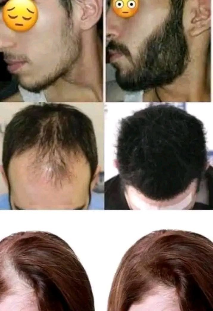 💥💥جديدنا 💥💥
زيت لنمو وزيادة كثافة الشعر واللحية
يعزز من نمو وكثافة الشعر . يعمل على تكثيف عميق ويسهل من تصفيف الشعر المجعد ؛ يزيد لمعانه ويغذيه . 
✅️ غني بمجموعة متنوعة من العناصر الغذائية الطبيعية 
☑️️ يقوي من يصيلات الشعر الخاملة
✔️ نتيجة سريعة جداا خلال ايام معدودة
✔️يصلح للبشرة الحساسة والجافة 
✳️️ يصلح ويفعل من نمو الشعيرات الخاملة

نص مكتوب في الصور:
- الحل لنمو وتكثيف اللحيه بوقت قياسي جدآ زيت اصلي خاآم
- السلام عليكم
- شلونه مكثف اللحيه
- اللي استخدمه
- ردت أسألك قبل فتره ونسيت
- تم الرد عليك بواسطة محمد
- وعليكم السلام
- منتج فول عاشت اديكم
- الحمدلله
- لقد قمت بالرد على محمد
- الف عافيه
- ربي يوفقكم شكراً ويوفقك ٩:٠٠ م BLOOM خوش كولش حلوه النتيجه استمر اؤؤك