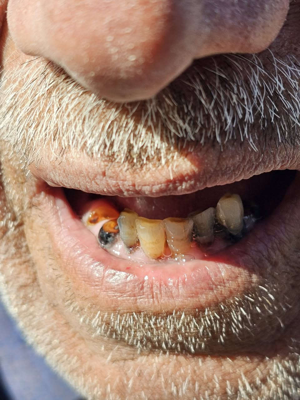 السلام عليكم و رحمة الله
مثل ما تشوفون بالصور كل هل حالات الي موجودة هي الها حلول ان شاء الله يمنة و نگدر نساعدكم بعلاجها تگدر تشوف الصور و تحدد لي شنو المشكلة الي تعاني من عدها و ما عليك الا ان تراسلنا و احنا ننطيك خطة العلاج الكاملة و كل هذا الشي مجاني و تحت اشراف اطباء اختصاص 

📍 الموقع: تقاطع القدس – جامعة بلاد الرافدين
🏥 عيادة كلية طب الأسنان
📞 للحجز والاستفسار: *********** واتساب فقط
