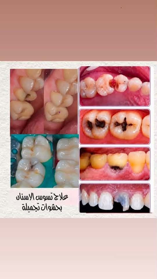السلام عليكم...
نستقبل الحالات التالية في عيادات طب الأسنان

• تنظيف الأسنان من التصبغات و التكلسات

• حشوات تجميلية (ضوئية)

• قلع الأسنان و الجذور التالفة

 •تعويض الأسنان بالطقم الجزئي

العنوان : بغداد - الدورة-شارع 60

علما أن العلاج مجاني وتحت إشراف أطباء اختصاص.

للحجز والأستفسار:

***********

نص مكتوب في الصور:
- قلع الأسنان والجذور التالفة
- تنظيف وازالة التصبغات
- BEFORE
- تعويض اسنان
- طقم متحرك
- علاج تسوس الاسنان بحشوات تجميلة
