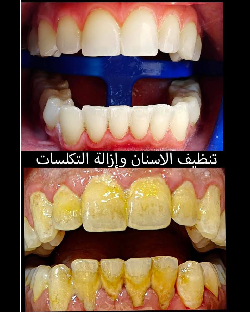 تنظيف أسنان • إزالة تكلسات • الاحرار