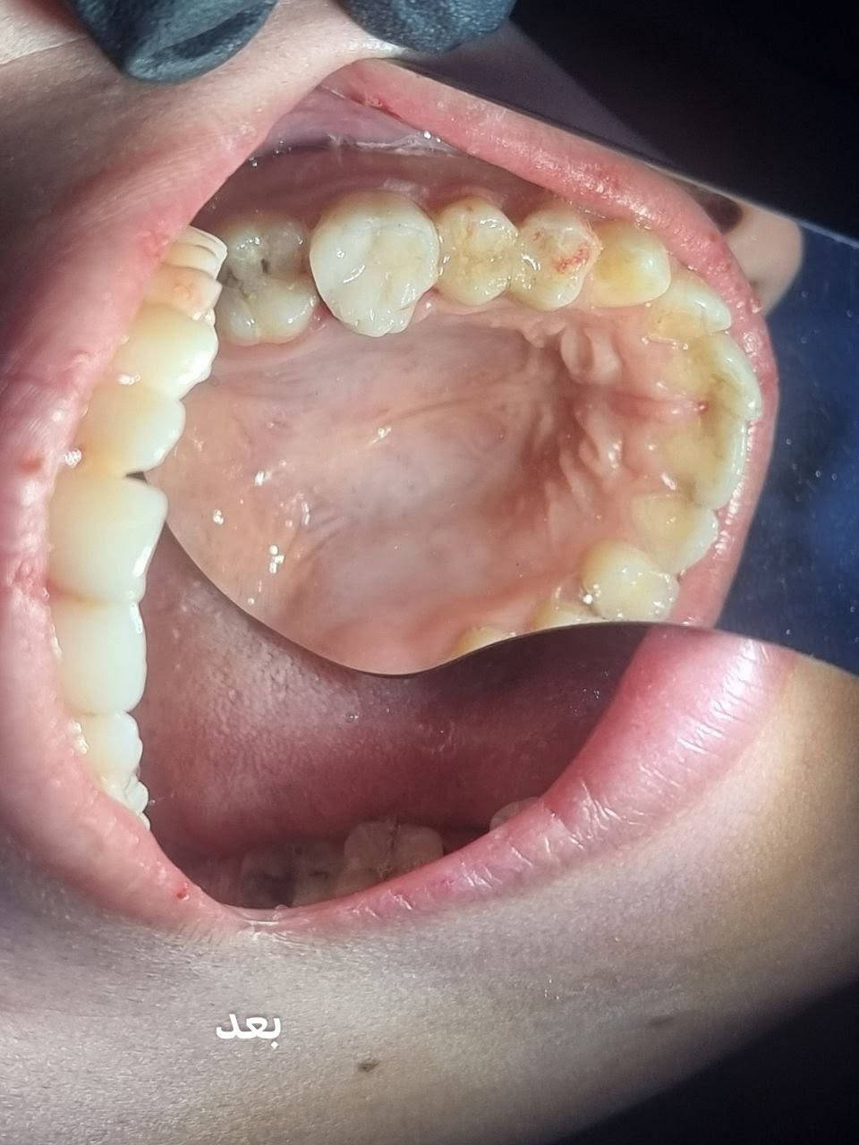 من أعمالنا اليومية في عيادتنا✨💙

إعادة ترميم للطاحن العلوي بالحشوة التجميلية🦷

#عيادة_كوثى_لطب_وتجميل_الاسنان
#الدكتور_علي_حسن_العزاوي 
جبله/نهاية شارع الاطباء
مقابيل الدكتوره ميثاق المعموري

***********//للاستفسار او مراسلة الحساب خاص
