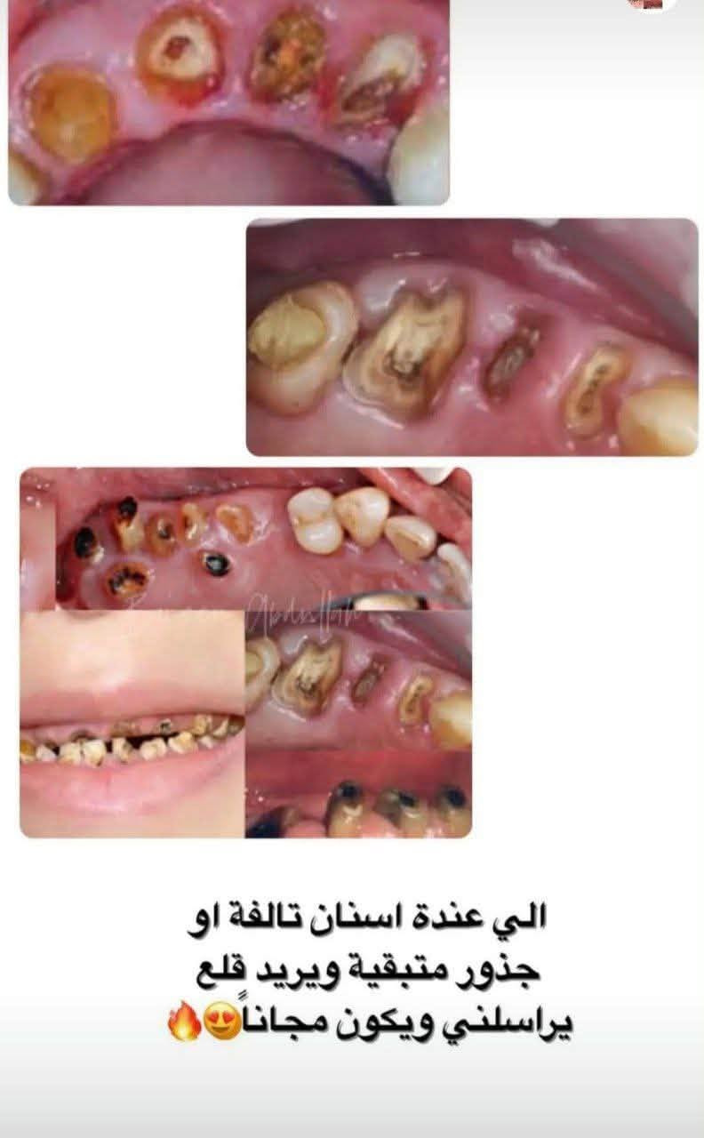 تعلن عيادات جامعة المنارة عن استقبال المرضى لإجراء العلاجات السنية مجانًا 🤍
• حشوات
• تنظيف وإزالة التكلسات
• قلع
• علاج جذور
• وغيرها من العلاجات حسب الحالة

📍 الموقع: عيادات جامعة المنارة – قرب مستشفى الصدر

📞 للاستفسار والحجز:
***********

نص مكتوب في الصور:
- اللي محتاج حشوات أمامية مثل هذه الصور يراسني العلاج مجاناً
- يل عده هيج حالات تستحق قلع من أسنان تالفه او لبنية أو بقايا جذور يتواصل ع الخاص حتى نثبتله حجز ✨ مجاناً
- طقم جزئي متحرك لشخص فاقد اسنانة نسويلة طقم مجانا 🤍🦷
- الحالات التي نستقبلها داخل العيادات علّما أن المعالجه مجانية حشوات معدنية و ضوئية قبل بعد قبل بعد قبل بعد قبل بعد
- الي عندة اسنان تالفة او جذور متبقية ويريد قلع يراسني ويكون مجاناً