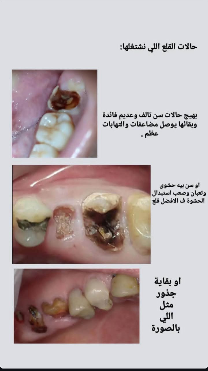 سلام عليكم
علاج مجاني للأسنان بالناصرية اللي عنده مثل هالحالات يتواصل ويانة ع الخاص أو على الواتساب 
***********

أو انستگرام 
dent.zainab_11

📍العنوان عيادات الجامعة الوطنية 
شارع ابراهيم الخليل مجاور ملعب التضحية

