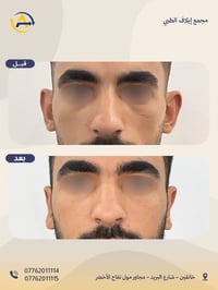 تعديل الأذن • أذن بارزة • خانقين