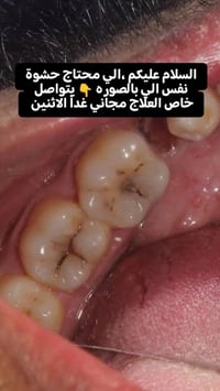 حشوة • علاج مجاني • طب أسنان ذي قار