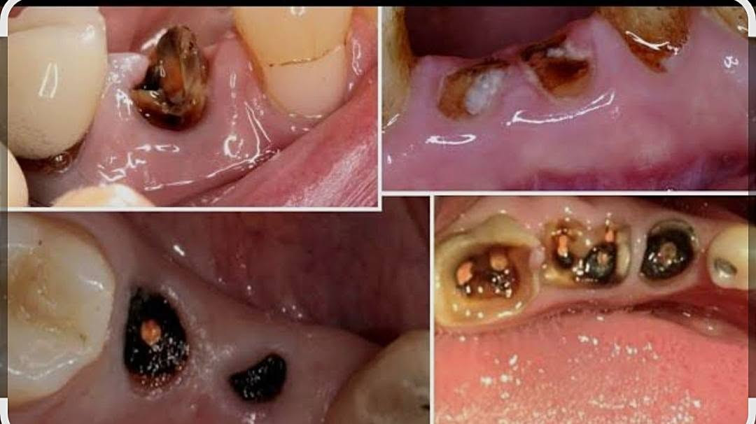 مجاناً العلاج مجاني بالكامل اذا 
عندك سن مكسور؟ جذر متبقي؟ أو سن يحتاج قلع؟
لا تخلي المشكلة تكبر 🌷
📍 المكان: بغداد – الدورة
نهاية شارع 60 – عيادات جامعة الهادي
📌 يتم فحص الحالة وتقييمها أولًا، وتحديد إمكانية القلع حسب حالة السن.
💗 الخدمة مجانية
📩 للحجز والاستفسار: راسلونا على الخاص.
 واتساب: ***********
