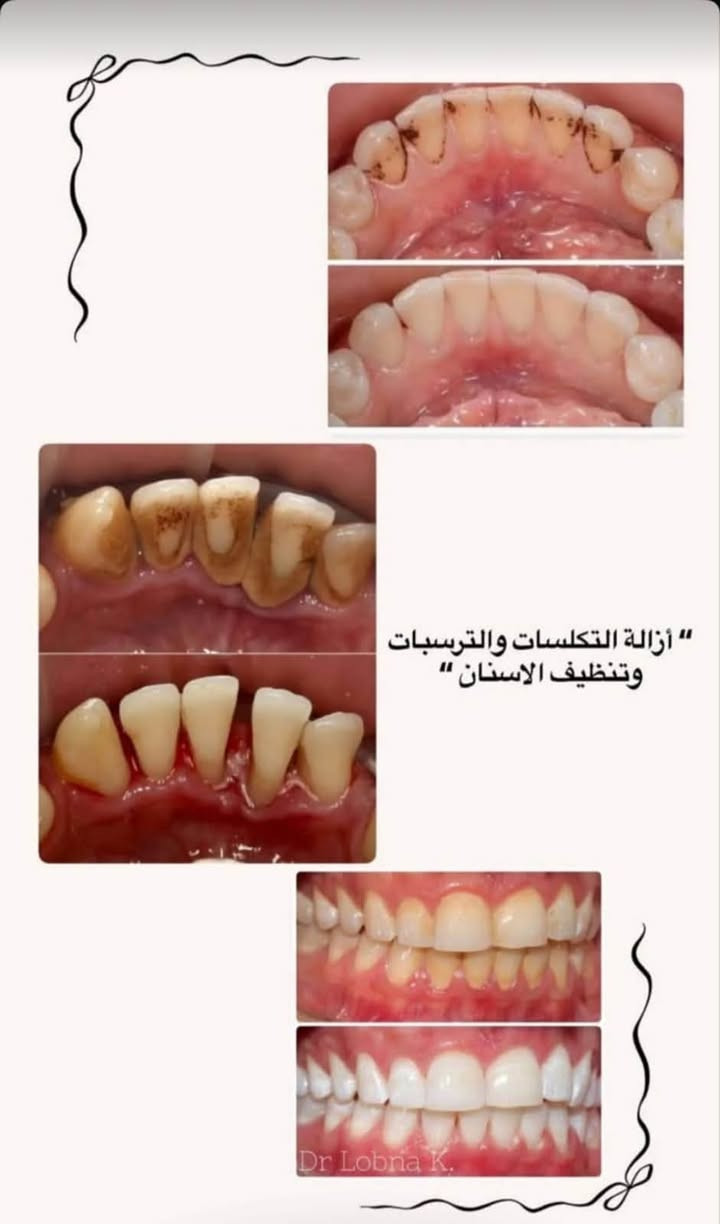 علاج الأسنان بشكل مجاني
وبإشراف أطباء إختصاص للي محتاج أي من الحالات التالية :
حشوات ضوئية (بيضه )
قلع الأسنان التالفة و الجذور
طقم جزئي متحرك
تنظيف الأسنان ( للي عنده تكلسات)

لحجز موعد التواصل مع الحساب 
تلواصل
 فيس Rana Ahmed
@dr_rana_dentalانستا 
تلي @Rayoun55
***********

نص مكتوب في الصور:
- قلع الأسنان التالفة والجذور المتبقية
- أزالة التكلسات والترسبات وتنظيف الاسنان " Dr Lobna K.
- هاي الحالات الي نستقبلها ب عيادات الجامعة  👇 الحشوات الضوئية والتجميلية أستقبل كل حالات التسوس الموضحة بالصور "
- نباوي❤️
- قبل ٥٣ دقيقة
- متوفر طقم جزئي للحالات: