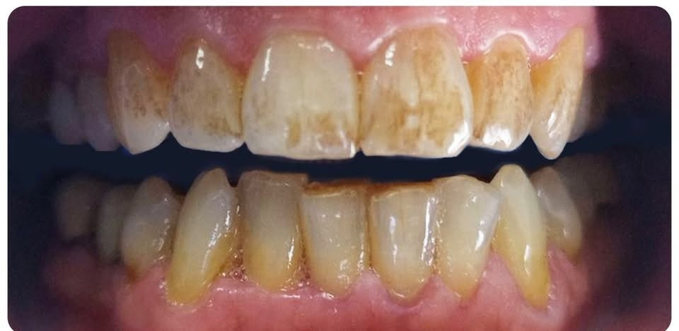 السلام عليكم
🦷🦷متوفر 
⭕️حشوات تجميلية 
 ⭕️تنظيف اسنان 
⭕️قلع الاسنان والجذور المتبقية 
⭕️طقم اسنان جزئي 
❗️العلاج تحت إشراف اطباء اختصاص 
📍العنوان : الدورة / ابو دشير / جامعة كلكامش
 
📞 واتساب :
 ***********
