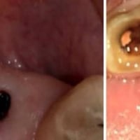 خدمات مجانية • علاج تسوس • قلع أسنان