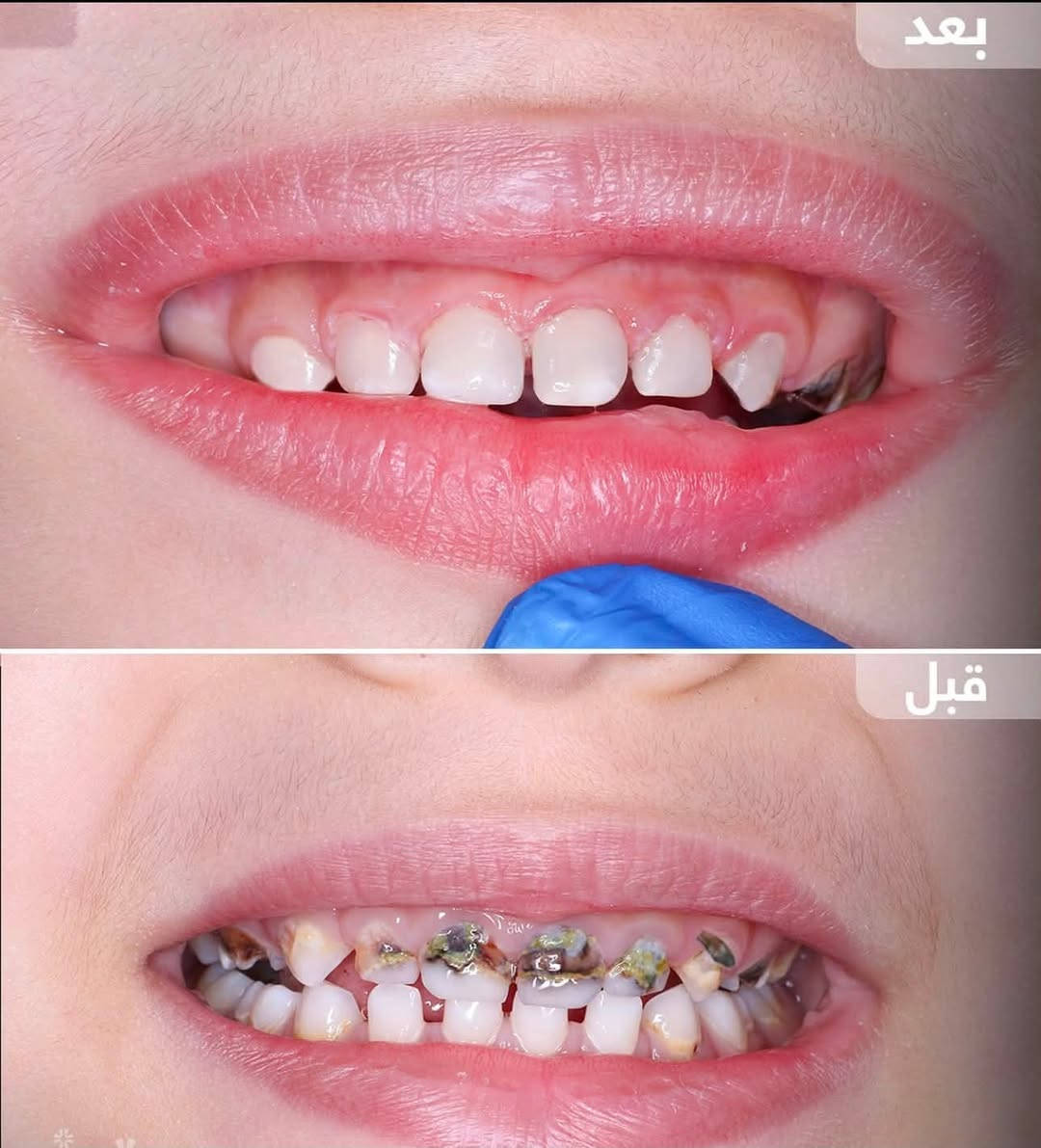 طقم متحرك كامل • حشوات تجميلية • قلع أسنان