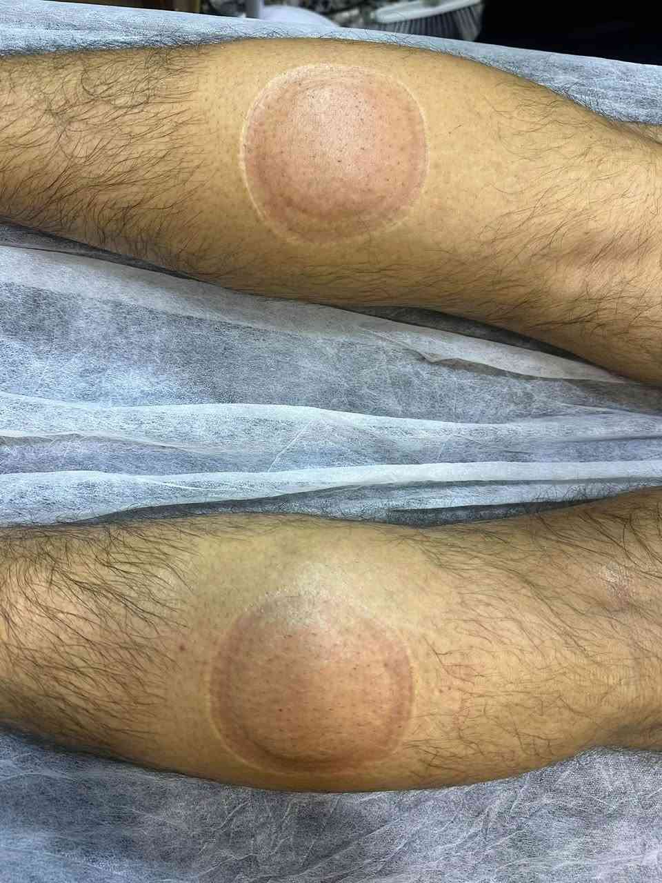 حجامة • مساج ساق • الطوبجي