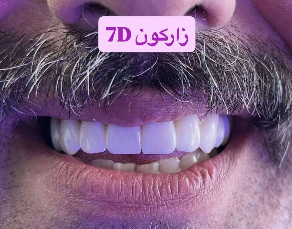 خلي ابتسامتك احلى واجمل مع عيادة ننسوتو😍✨💜
نعالج اسنانكم بجميع انواع الابتسامات :

-الايماكس
-الزاركون المطعم بالايماكس
-الزاركون 7D
-الزاركون الطبيعي

تحت ايادي اطباء مختصين بمجال الابتسامات وبطريقة علمية صحية ..
العنوان :الزعفرانيه اربع شوارع اكبال ابو علي منزليه جنب مركز شاليه للعناية بالسيدات 
يتوفر نظام الاقساط لموضفي ومتقاعدين المصارف (الرشيد ، الرافدين
للاتصال***********او***********

نص مكتوب في الصور:
- E max ایماکس
- زاركون 7D
- زاركون مطعم بالايماكس