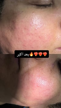 حجز • صالون تجميل • بعد الابر