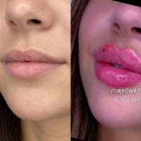 رسم الشفه بشكل احترافي  مواد اصليه خبره عاليه راحه وأمان موقعنا بغداد ...