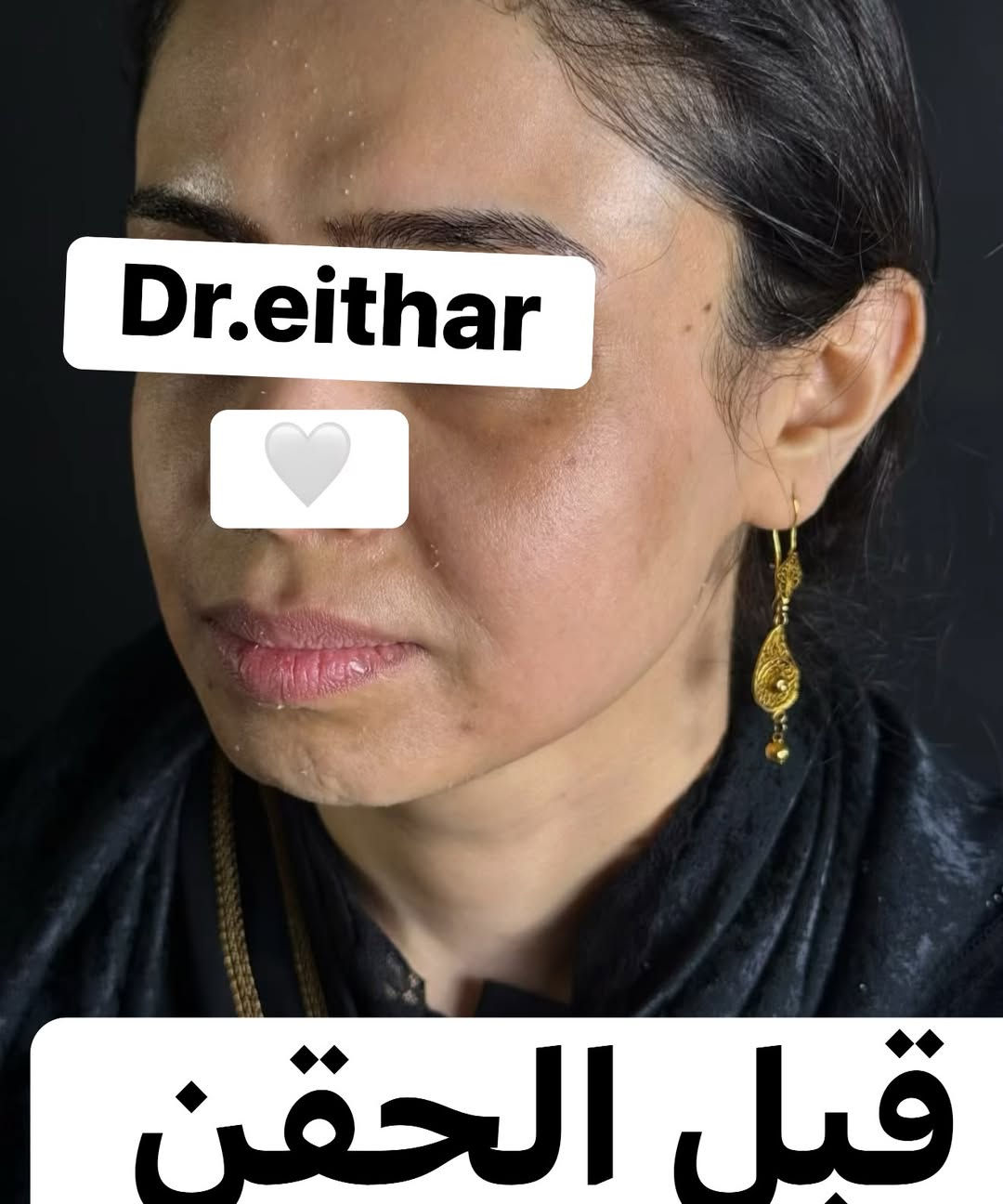 استداره الوجه كامله (لفتنك وجنات واصداغ وتدوير الفك والذقن ونظاره) والشفة🔥🔥

عروووض فرحة الزهره ثبتتهه الكم بالستوري بالهايلايت وببوست اعلى الصفحة ✨✨

د.ايثار سامي عبد الامير
واسط الكوت الهوره مجمع القبطان طابق اول 

الحجز***********
