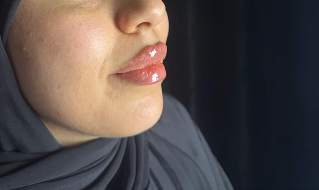 خلي ابتسامتج تحچي عنج… وشفايفج تكمل جمالج. 💋
* لأن الجمال الحقيقي هو التناسق، مو المبالغة
الدكتورة ساره عدنان
