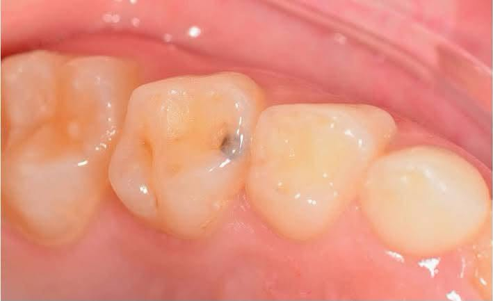 عندج هيج تسوسات؟علاجها مجاناً 🟢
📍 الموقع: عيادات طب الأسنان – جامعة كربلاء- حي الموظفين - شارع مستشفى الولادة 

📞 للتواصل والحجز: ***********

رجّع ابتسامتك وثقتك… لأن التفاصيل الصغيرة تغيّر هواي 🌿⁩

