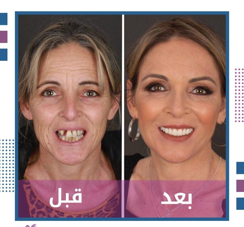 تنظيف أسنان • حشوات تجميلية • الدورة حي الصحة
