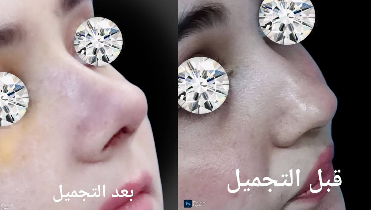بعد رفع القالب مباشره
Natural Rhinoplasty
Alyasiery clinic for Rhinoplasty
***********
