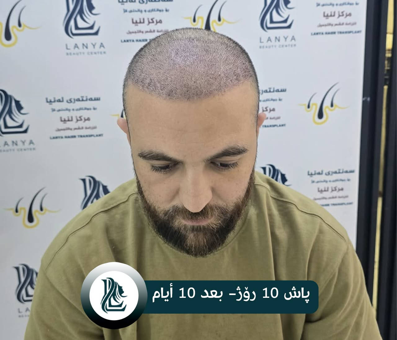 زراعة شعر • لەنیا • كلار