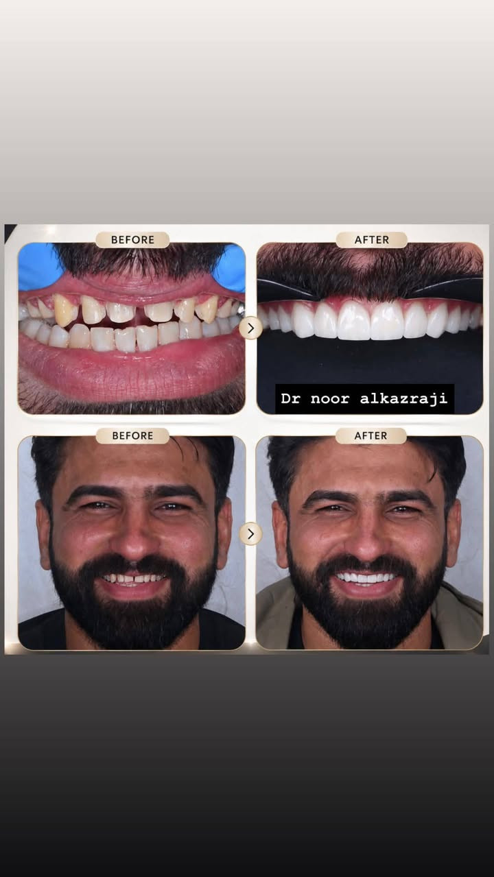 بسم الله وعلى بركة الله ستتواجد الدكتوره نور علي الخزرجي في عيادتها عيادة( the moon light ) لطب وتجميل الفم والاسنان والوجه والفكين
الواقعه في سوق الخالص قرب فرن صمون البركه مجاور مفروشات الزهراء  (وكذلك قسم التجميل الدكتورة ضحى حسين الگمر). يوميا  من الساعه الرابعه عصرا الى الساعه الثامنة مساءا باستثناء يوم الجمعة عطلة العيادة نستقبل حجوزاتكم بكل حب على الرقم *********** وراح تكون اكو هدايا حلوه ومميزه (حقن بلازما وتننظيف اسنان وتبييض اسنان بالليز وكذلك خصم على كافه الحشوات وحشوات الجذور  بنسبة ٢٠٪لمراجعين العياده في الاسبوع الاول من افتتاحنة حبا واحتراما لكم❤️
بسم الله وعلى بركة الله ستتواجد الدكتوره نور علي الخزرجي في عيادتها عيادة( the moon light ) لطب وتجميل الفم والاسنان والوجه والفكين
