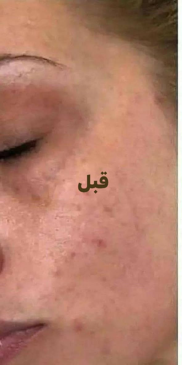 ✨ التصبغات وآثار الحبوب مو بس تغيّر مظهر البشرة، مرات تخلي لون البشرة غير موحّد وتحتاج عناية واهتمام مستمر.
بهالمنشور راح تتعرفين على أهم الأسباب، وتشوفين قبل وبعد من إحدى التجارب، وبالنهاية أشاركچ المنتج المستخدم في هذه التجربة: Forever Epiblanc 🤍🌿
إذا تعانين من التصبغات أو آثار الحبوب وتريدين تعرفين أكثر عن المنتج وطريقة استخدامه، راسليني خاص 💌
#فوريفر #Forever #Epiblanc #العناية_بالبشرة #التصبغات #آثار_الحبوب

نص مكتوب في الصور:
- بشرة صحية .. تبدأ من فهم الأسباب ♡
- أسباب التصبغات وآثار الحبوب
- التعرض المفرط للشمس
- تغيرات الهرمونات
- آثار الحبوب والالتهابات
- استخدام منتجات غير مناسبة للبشرة
- التوتر وقلة النوم
- العوامل الوراثية
- السبب معروف .. والحلم موجود ♡
- قبل
- بعد
- المنتج المستخدم في هذه التجربة
- Forever Epiblanc
- يساعد على توحيد لون البشرة وتقليل التصبغات
- يقلل التصبغات
- يوحد لون البشرة
- يمنح البشرة إشراقة طبيعية
- مناسب لجميع أنواع البشرة
- Healthy Skin Brighter You