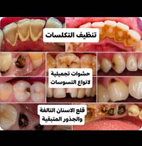 علاج اسنان مجاني • تنظيف اسنان • اطقم اسنان